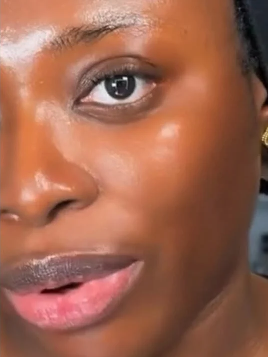 cheek and under-eye after pigmentation treatment