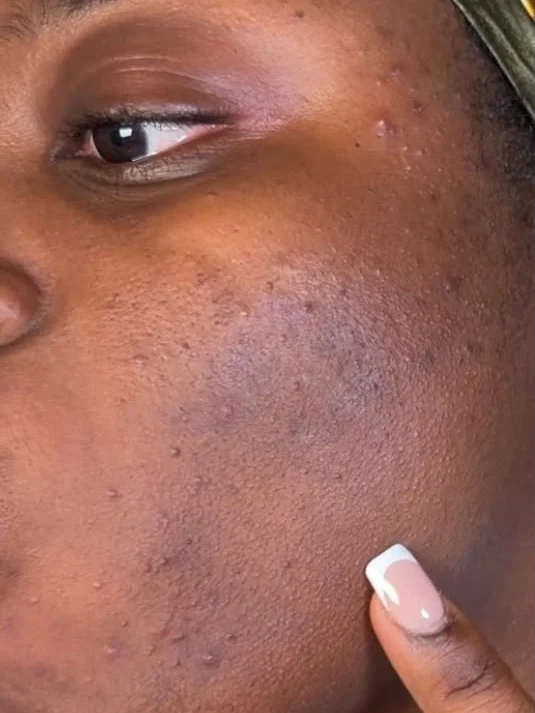 cheek and under-eye before pigmentation treatment